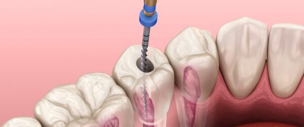 فایل روتاری دندانپزشکی